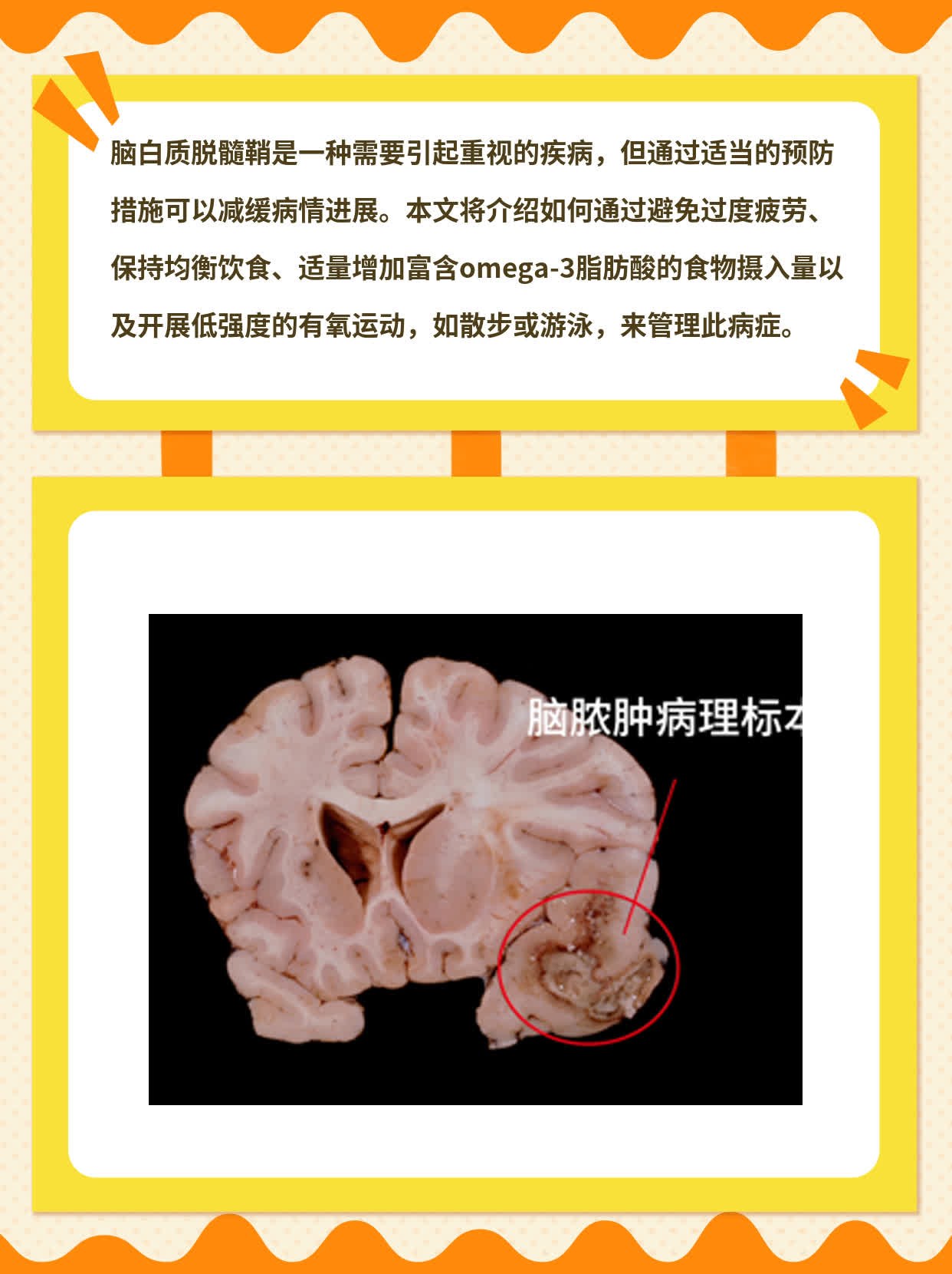 什么叫脑白质病_(脑萎缩主要表现的症状)