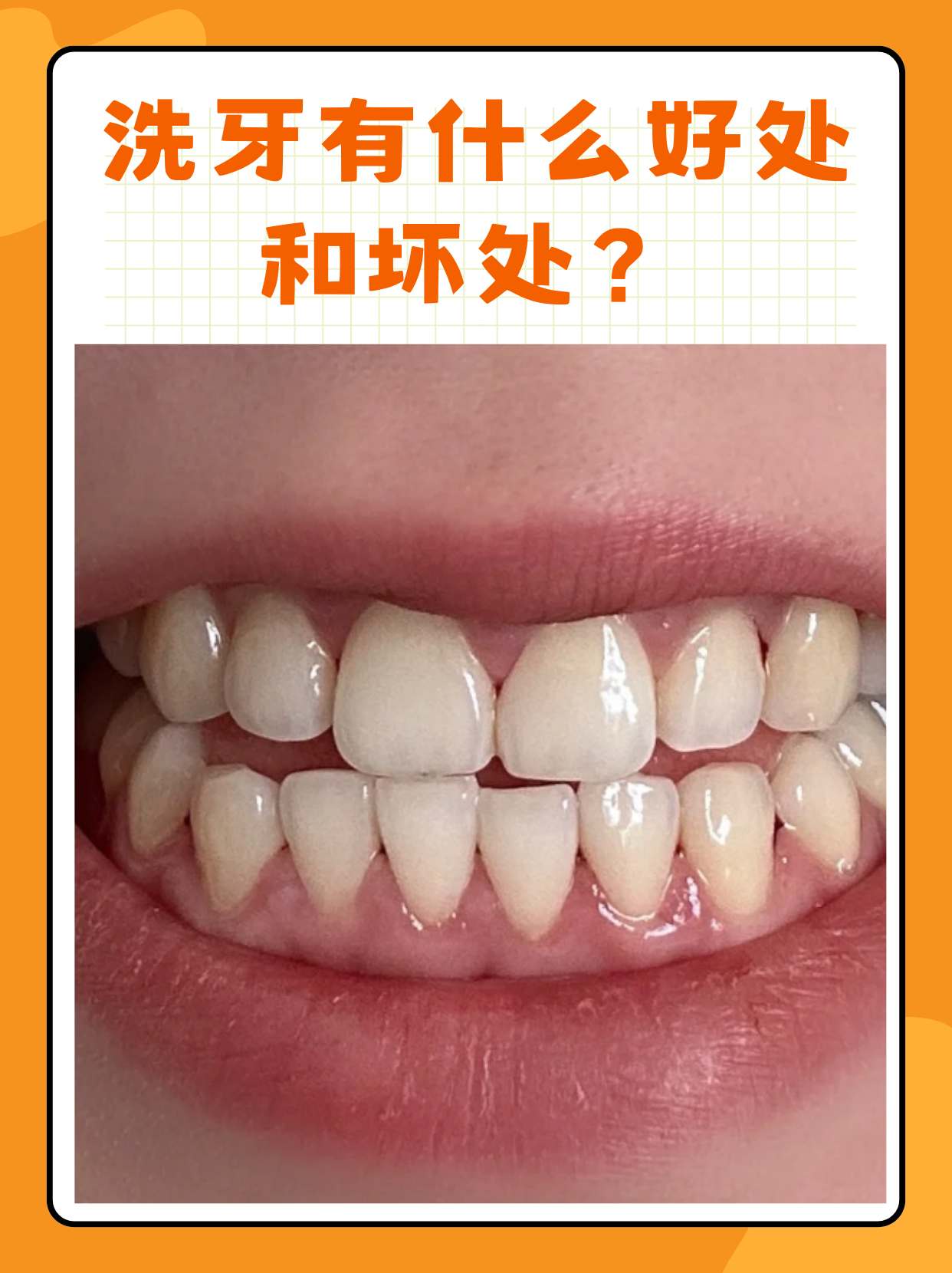 洗牙是磨牙吗(洗牙是磨牙吗还是磨牙)