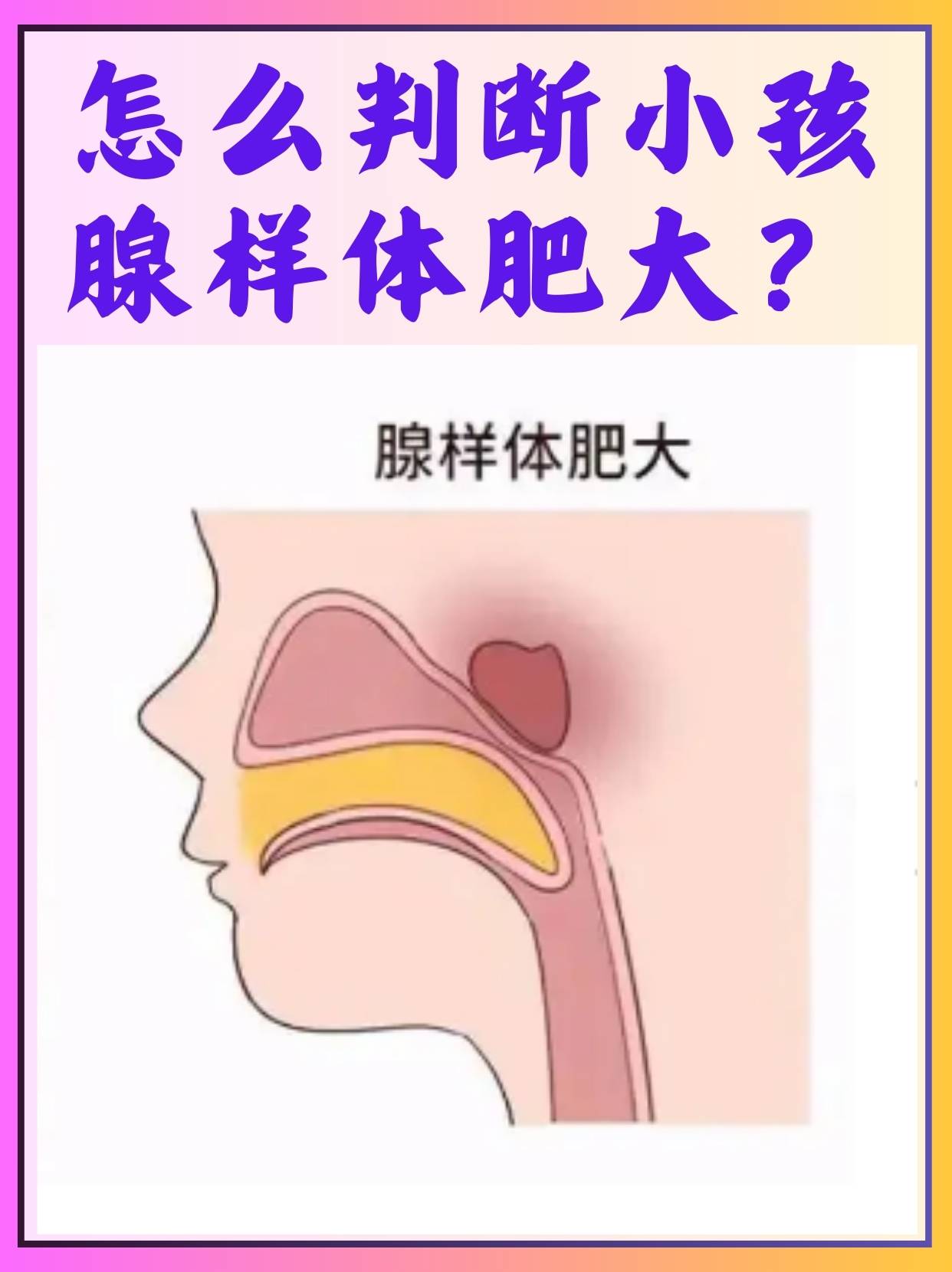 腺样体挂什么科(小孩腺样体挂什么科)
