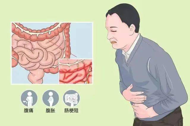 肠梗阻是什么意思-(不完全性肠梗阻是什么意思)