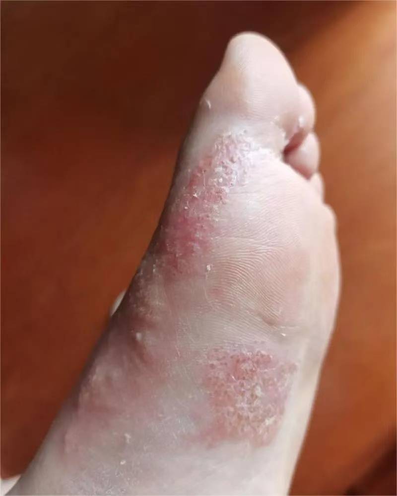 脚底出汗什么原因_(睡床上脚底出汗什么原因)