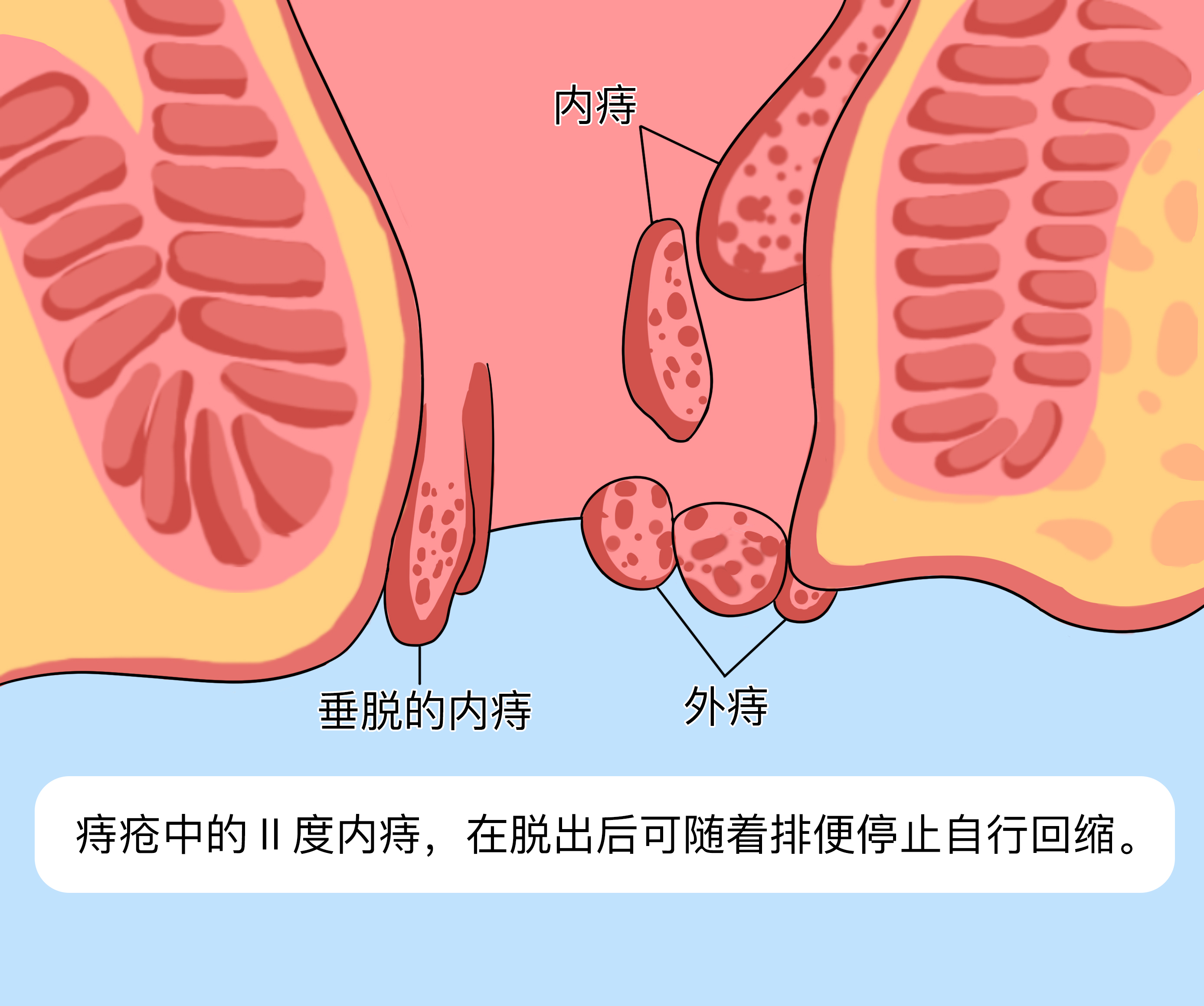 内痔疮的症状表现-(内痔疮的症状表现有哪些怎样治疗)