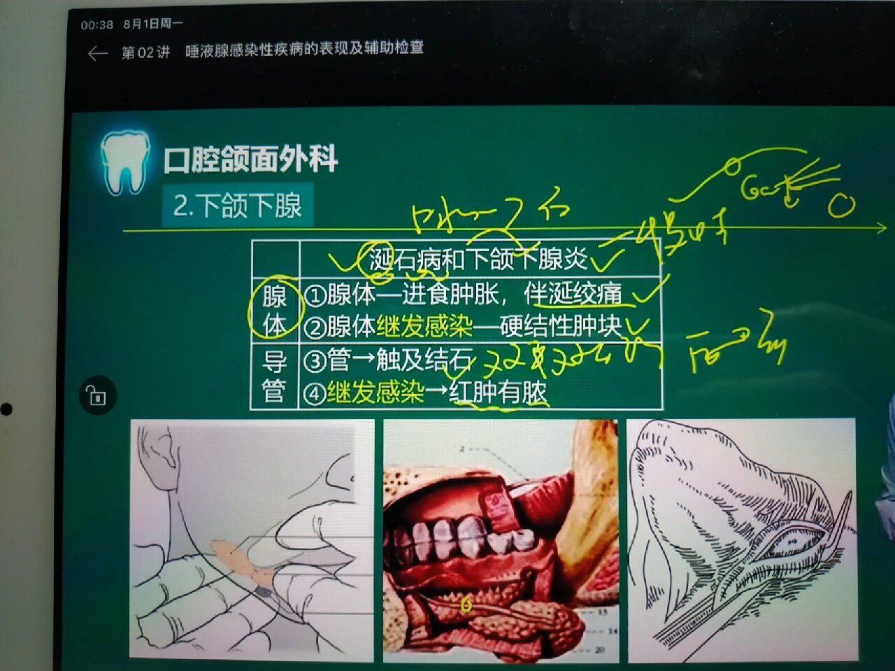 涎石病(涎石病最常见于)