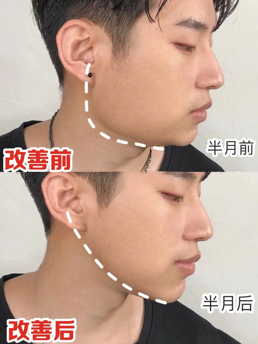 男生如何瘦脸_(男生如何瘦脸变v脸)