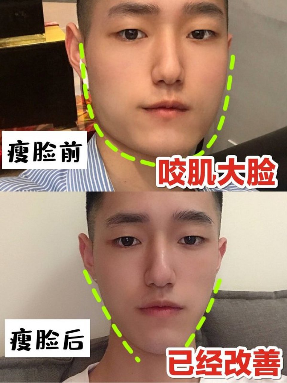 男生如何瘦脸_(男生如何瘦脸变v脸)