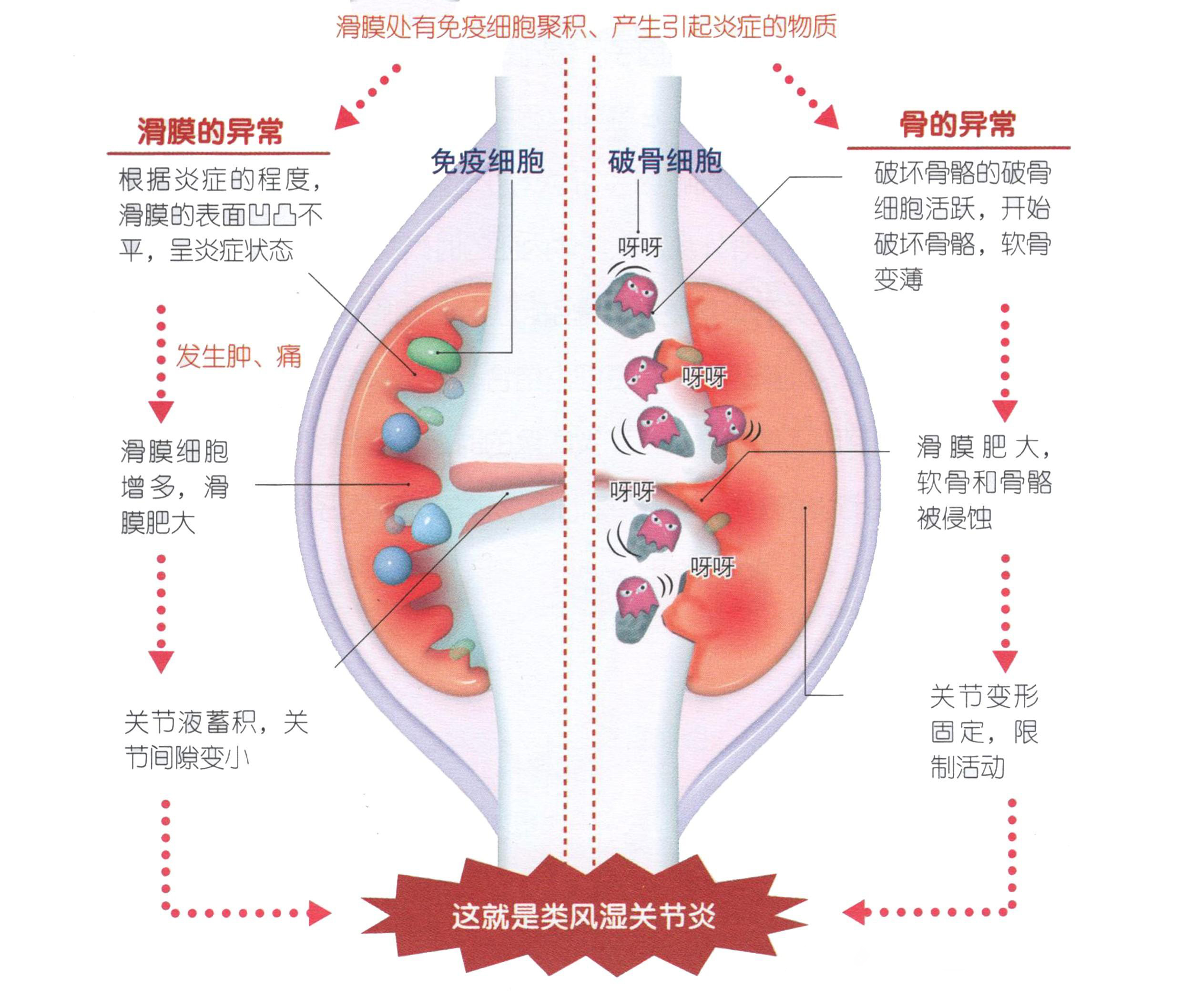 风湿是什么意思-(开玩笑说风湿是什么意思)