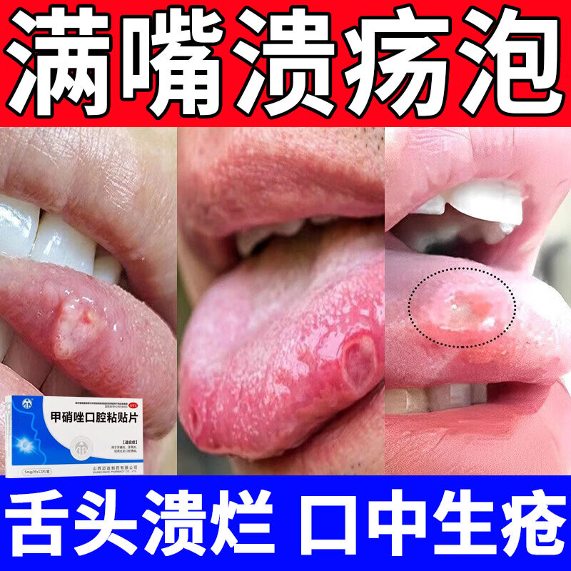 舌头溃疡怎么治_(舌头溃疡怎么治最快吃哪种维生素)