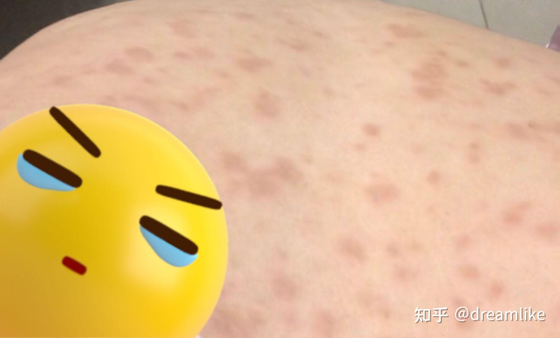 玫瑰糠疹痒吗_(玫瑰糠疹痒吗发生在什么季节)